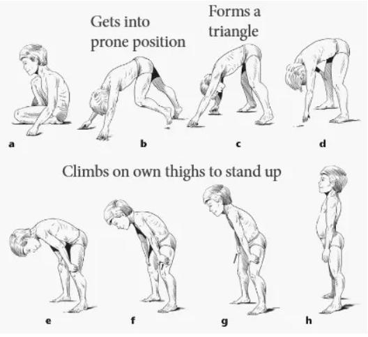 儿童皮肌炎的发病原因,儿童皮肌炎预后