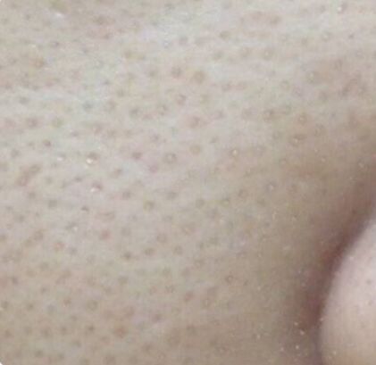 苨萃（NICUI）护肤：有哪些医美手段可以真正收缩毛孔？