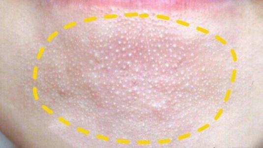 小孩子脸上长小米粒疙瘩怎么去掉,脸上有密密麻麻的小米粒是什么