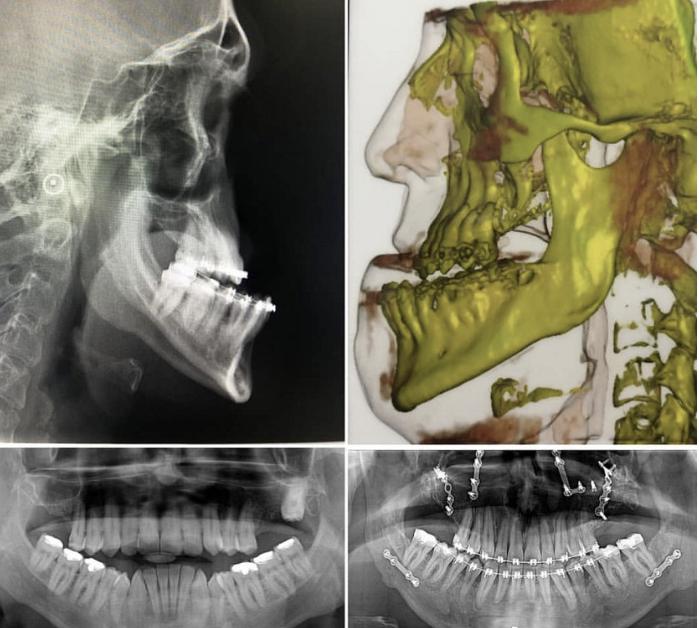 骨性地包天不做正颌手术最好方法,骨性地包天不做手术可矫正吗