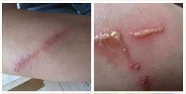 天热有蚊子宝宝怎么办,天热宝宝身上老痒怎么治