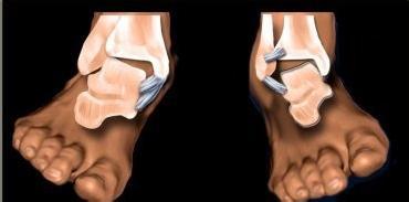 浅谈踝关节扭伤与创伤性关节炎,踝关节扭伤包扎