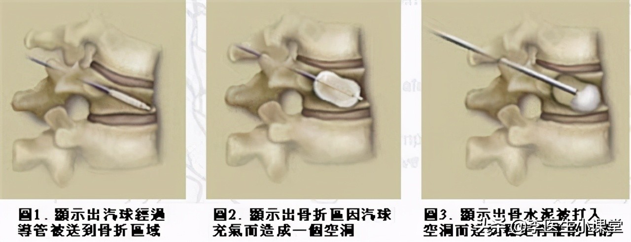 骨质疏松打一年一次的针能止疼吗,老年人骨质疏松最快的恢复办法