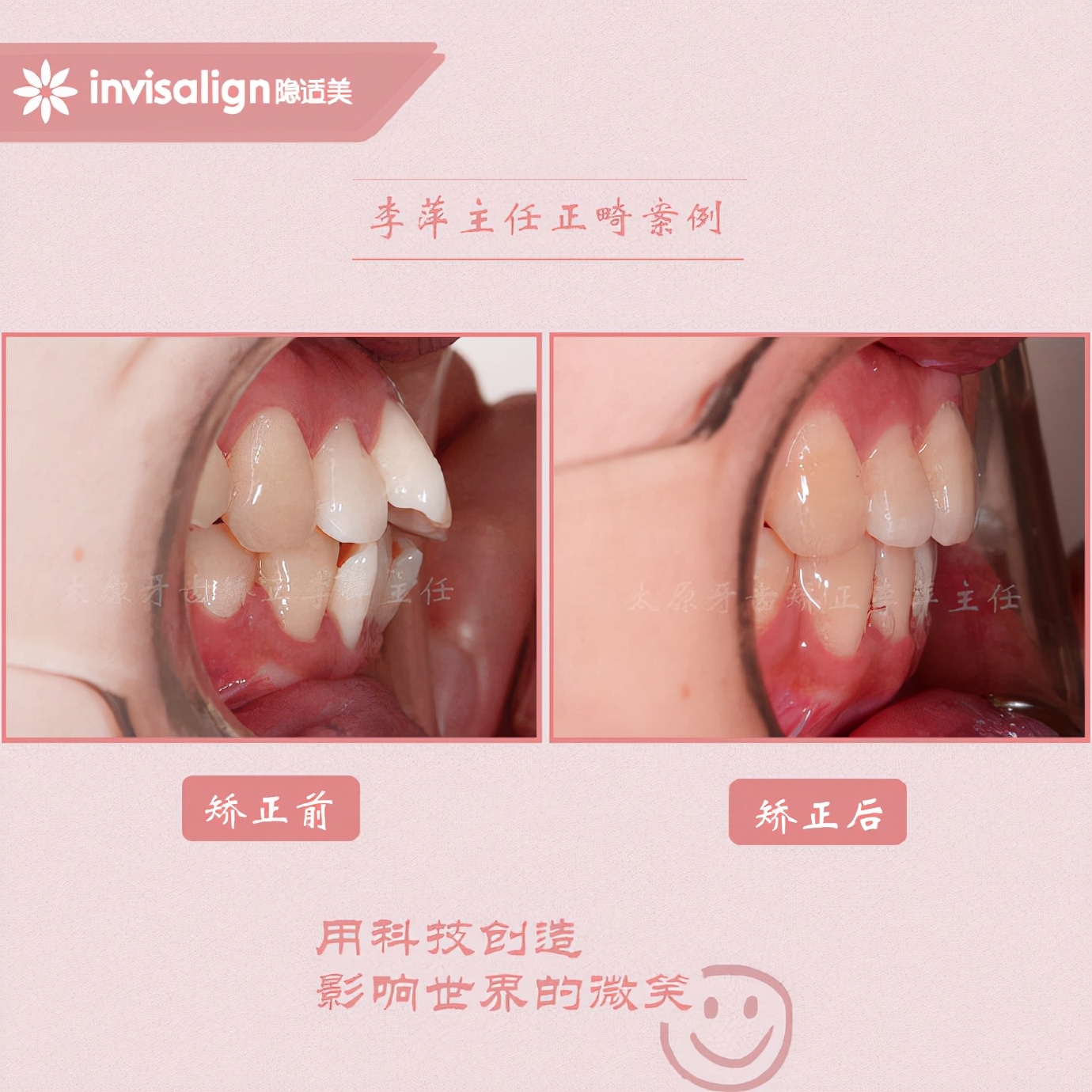 二甲医院骨性前突龅牙矫正多少钱,太原骨性嘴凸矫正牙齿图片