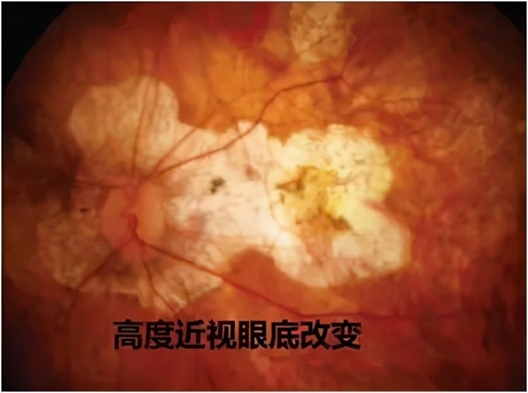 眼底刚查正常但突然有飞蚊症,眼病早知道的症状