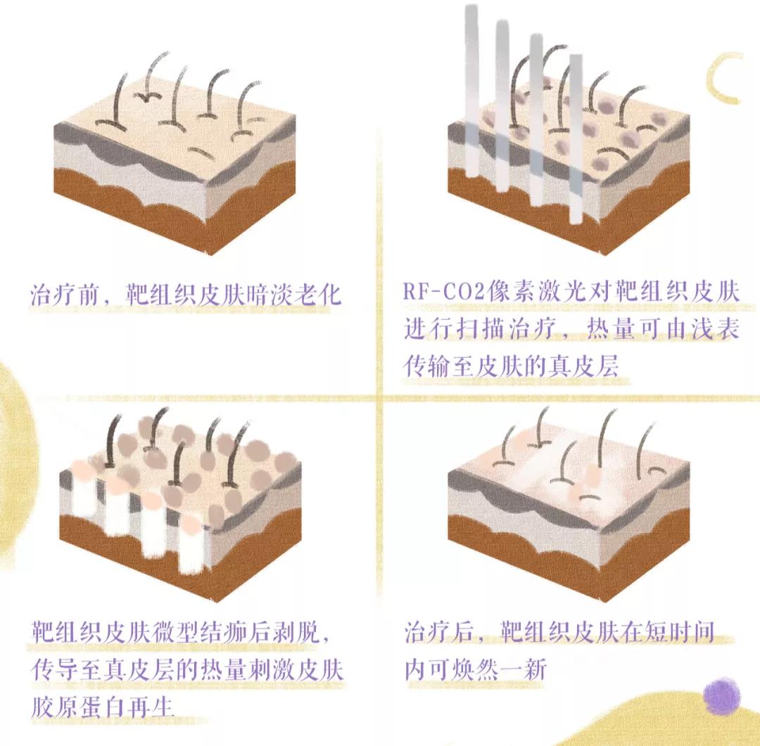 大痘印适合做什么医美,医美做什么可以去除痘坑
