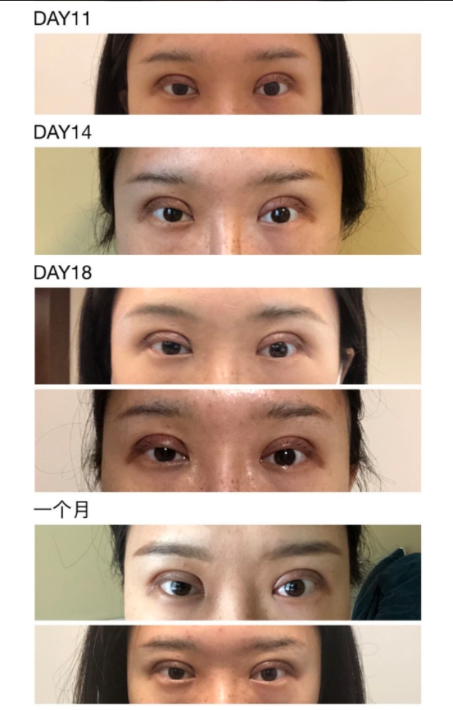 双眼皮前宽后窄算失败吗,双眼皮手术宽度是指恢复后吗