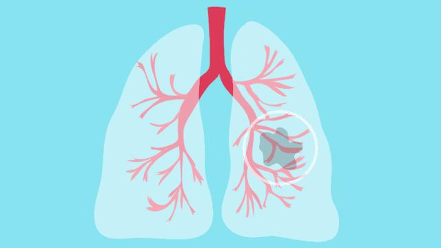 肺结节中间空洞消失变成实性结节,发现多个肺结节考虑原位癌