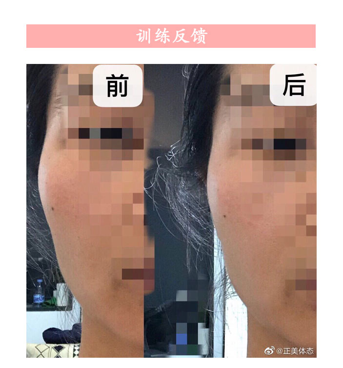 颧骨不一般高怎么矫正,颧骨紊乱的症状和矫正