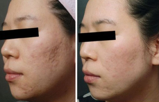 脸上痘印痘坑怎么消除最有效,痘坑怎么才能彻底解决