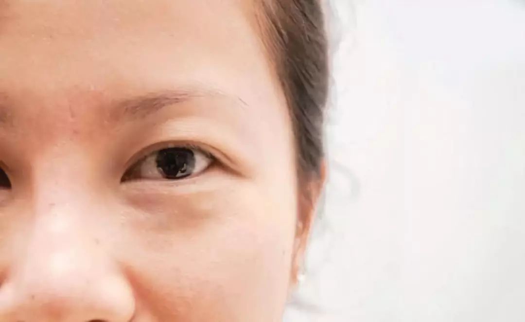 下眼袋浮肿与大眼袋区别,40岁消除眼皮浮肿和眼袋