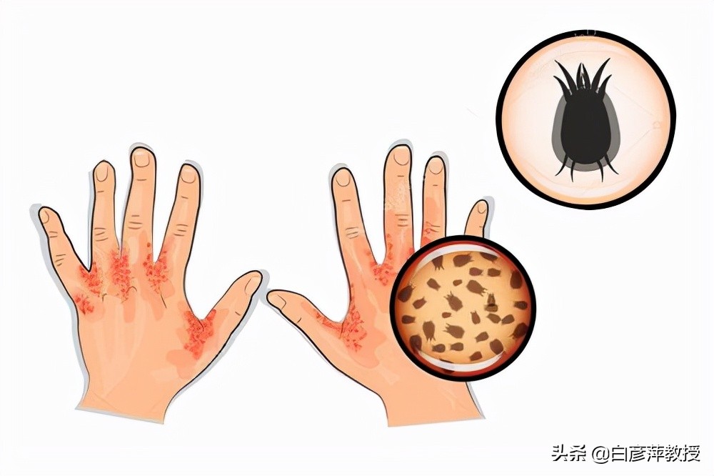疥疮？一种奇痒又会传染的皮肤疾病