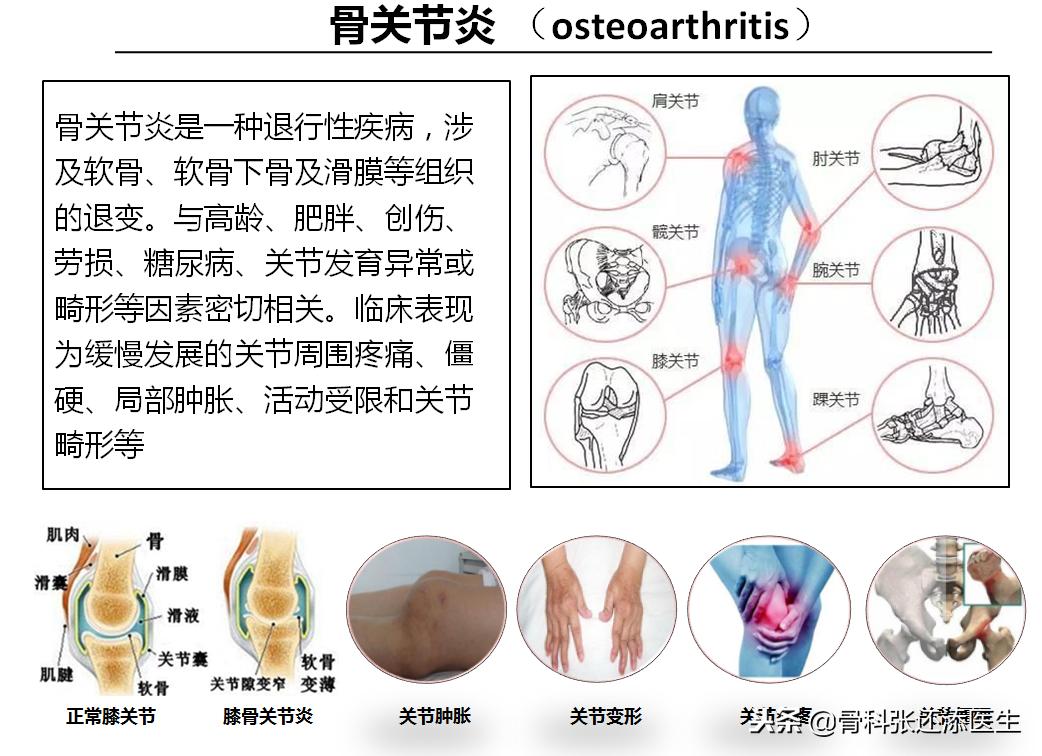 膝盖疼医生建议吃氨糖,医生告诉你膝关节疼痛的十大问题