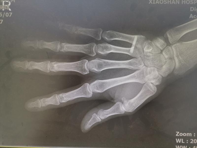 筷子开酒瓶视频火爆多人因模仿被扎伤手掌医生提醒存危险