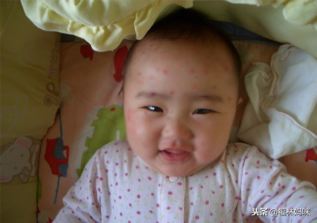 宝宝得了水痘用吃药吗,宝宝长水痘一定要注意什么