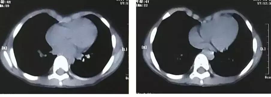「拿掉」胸上的「漏斗」，让这个孩子挺起胸膛