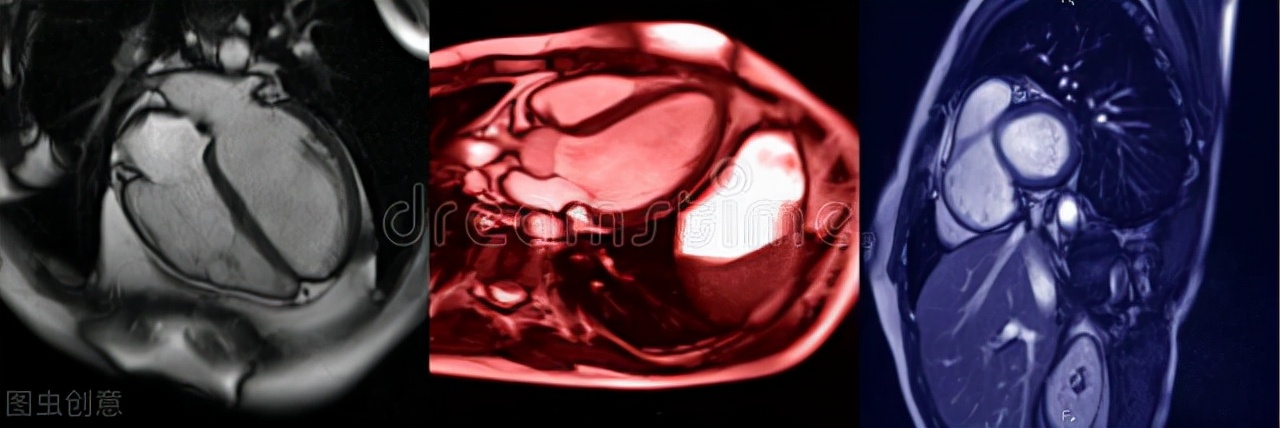胸闷气短心电图有变化,冠脉造影正常但有胸闷心绞痛症状
