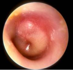 小孩说耳朵疼是中耳炎吗,儿童中耳炎引起的耳痛怎么解决