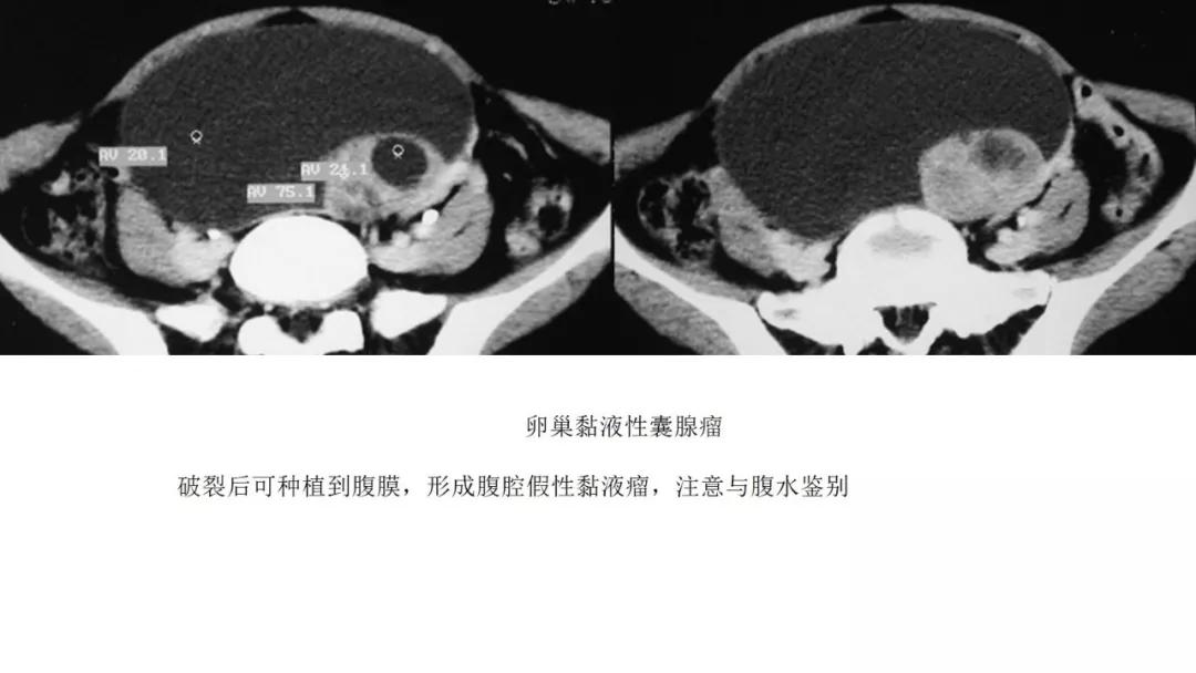 卵巢原发肿瘤的分析思路