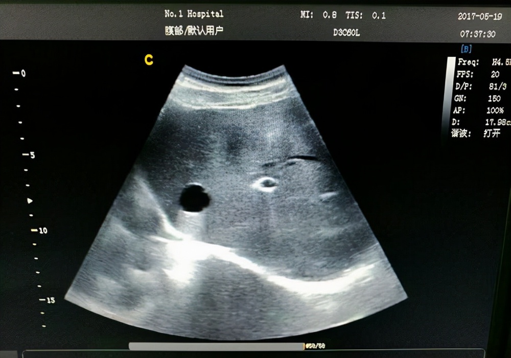 体检时发现这十种病是不要花钱的,体检发现这5种病无需过度治疗