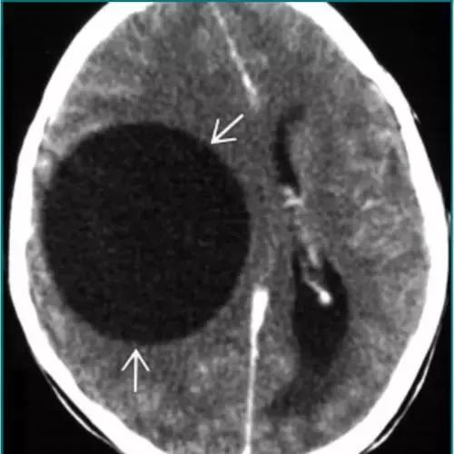 各种囊肿的症状,颅内囊肿18-19mm严重吗