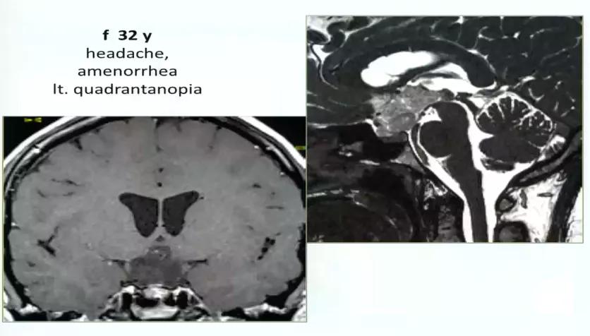 INC巴特朗菲教授视频|视神经-下丘脑胶质瘤全切案例集及治疗解读