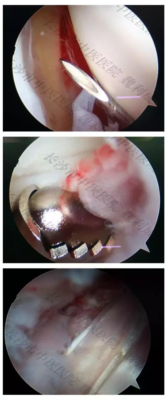 腱鞘囊肿除了手术还有什么办法,下颚有囊肿可以做穿刺手术