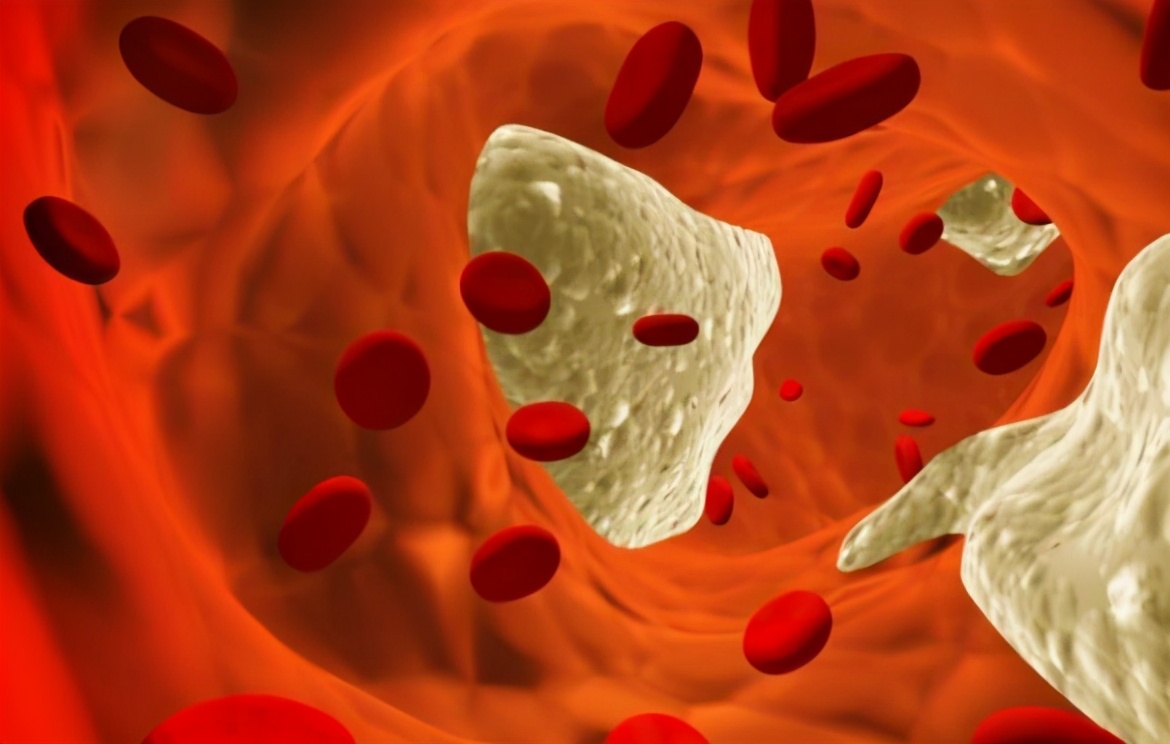 睡觉时有3个异常，十有八九血管已“堵塞”，做好2件事，血管畅通