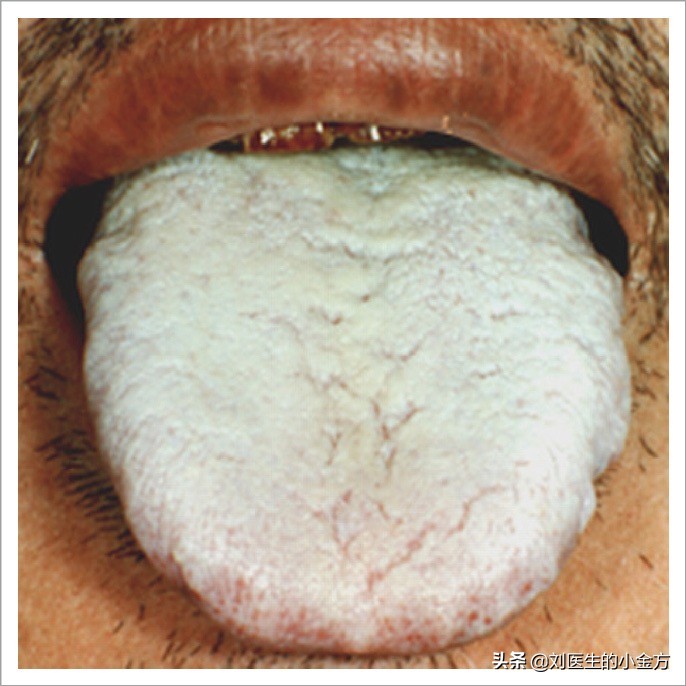 舌象图解大全中医舌诊,最全中医舌诊图谱来了