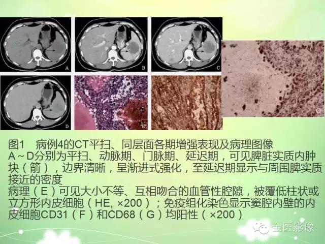 脾血管瘤中医辨证,脾血管瘤超声表现