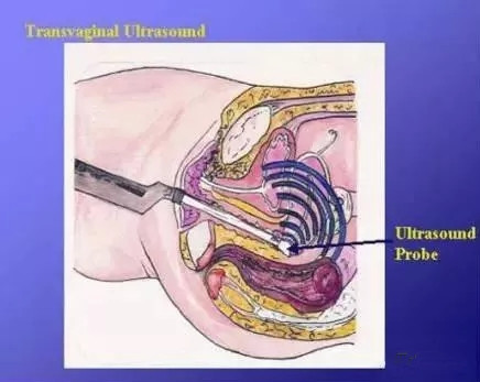 妇科阴式超声检查方法,盆底超声可检查什么疾病