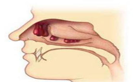 鼻内镜住院注意事项,鼻内镜手术后多久可以下床