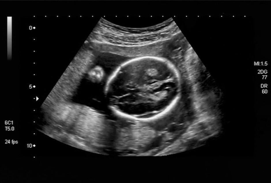 生化再次怀孕该注意事项,生化两次后再怀孕生化几率大吗