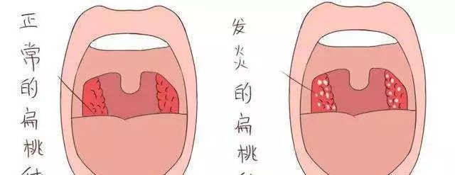 扁桃体发炎与扁桃体癌的区别,扁桃体瘤和扁桃体癌的区别