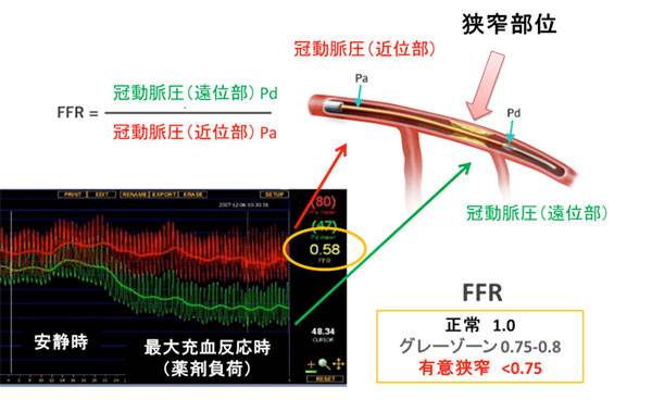 增强ct结果血管狭窄95%要做支架吗,50岁ct检查出冠脉钙化斑严重吗