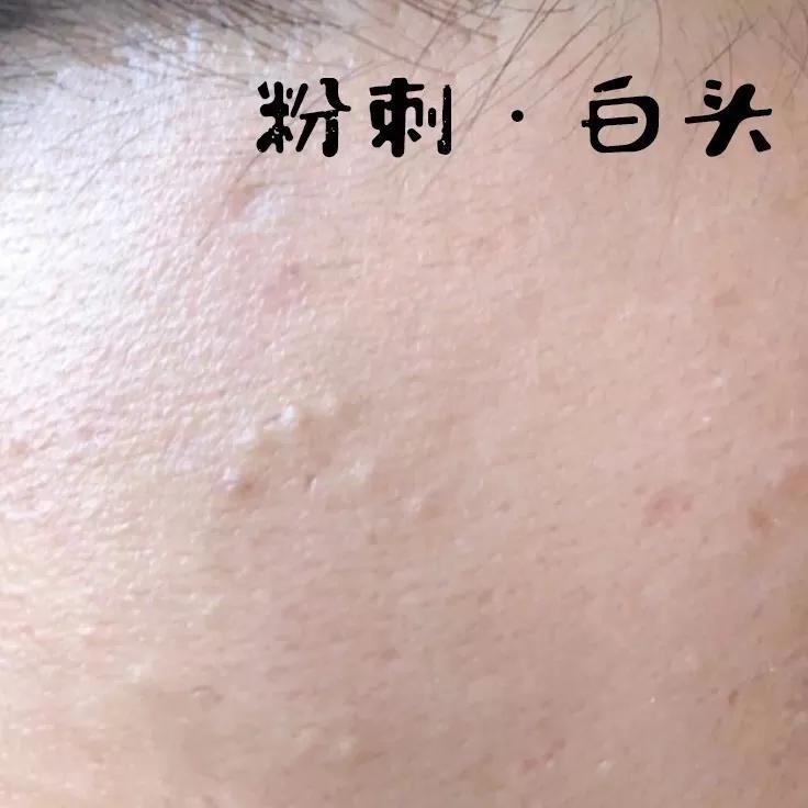 为什么你的痘印总是消不下去,为什么你的祛斑效果不理想