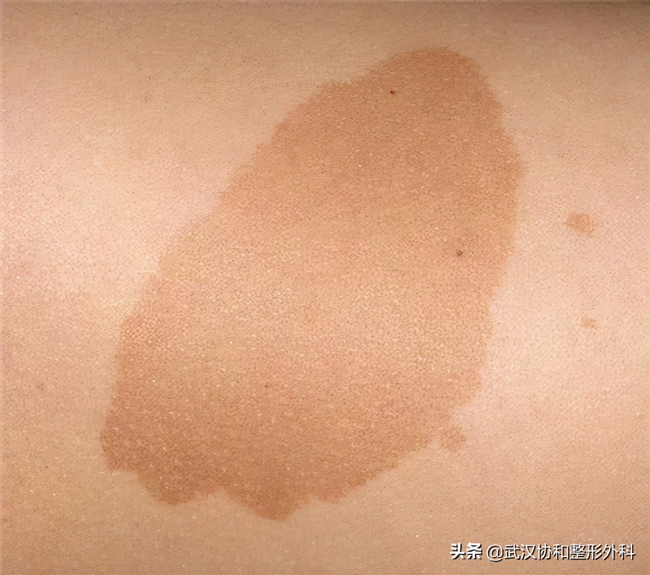 是“疾”不是“记”！警惕宝宝身上的“咖啡牛奶斑”