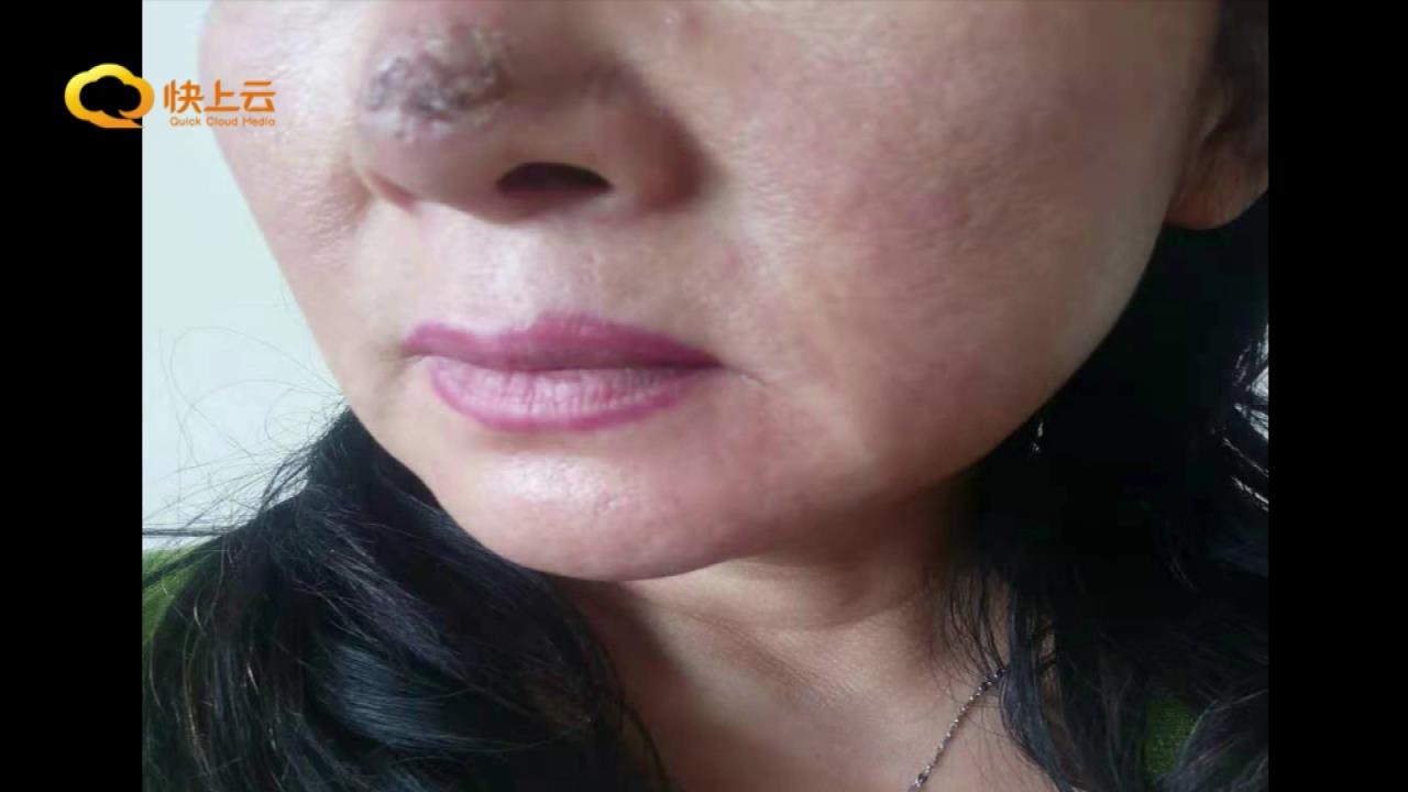 参加医美活动鼻部填充玻尿酸出现问题要说法博雅美容整形：没责任 法律途径解决