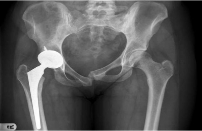 产前耻骨痛产后什么时候能恢复,产后20天突然耻骨痛是缺钙吗