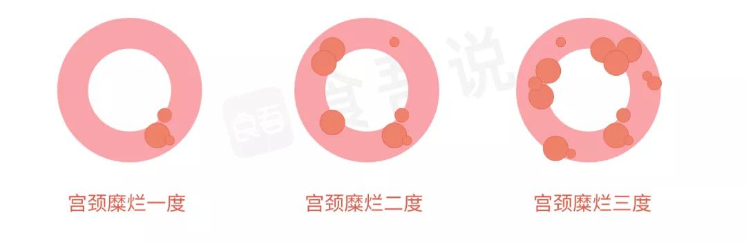 宫颈糜烂和宫颈癌的区别是什么,宫颈癌是不是宫颈糜烂引起的