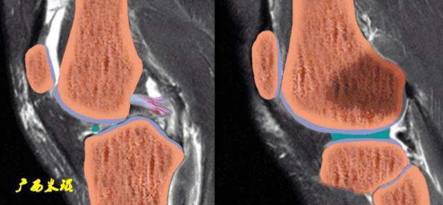 交叉韧带损伤的mr表现,后交叉韧带损伤的诊断实验