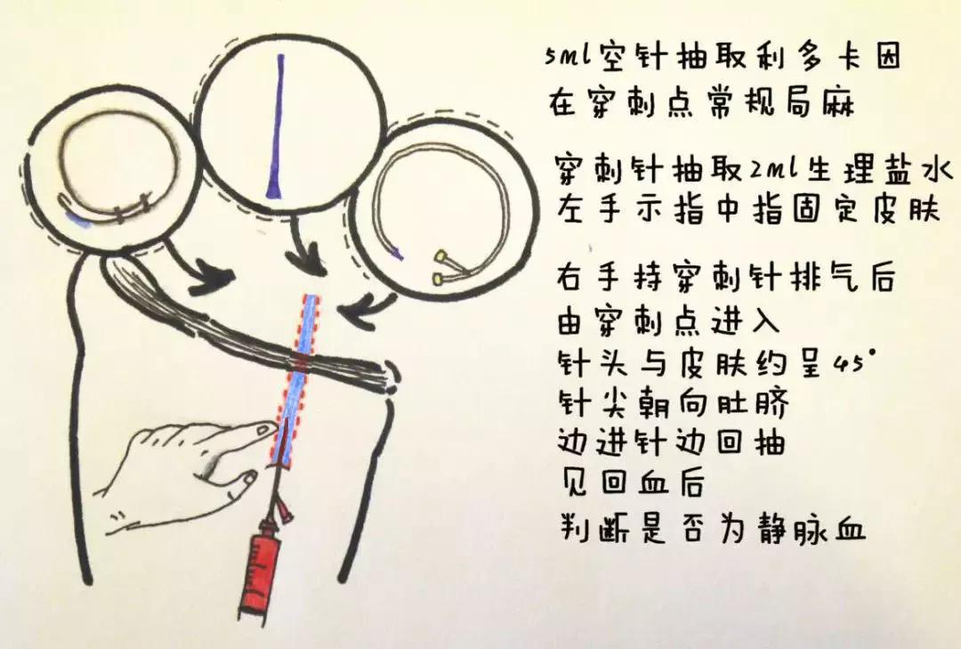 股静脉穿刺置管输液,股静脉穿刺置管术详细讲解