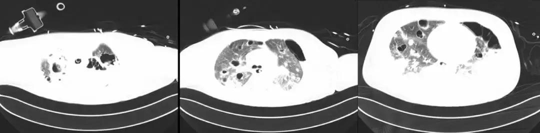 万古霉素治疗mrsa疗程,万古霉素用于mrsa的作用机制