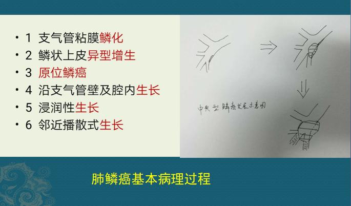 新冠肺部感染应对,新冠肺癌抗癌