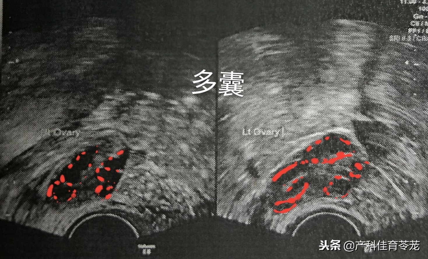 卵巢囊肿做了肿瘤标志物显示正常,卵巢囊肿内见密集光点正常吗