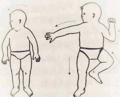 小儿脑性瘫痪的康复评估