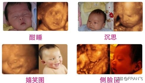 “四维彩超”主要查这些，准妈妈你都知道吗？