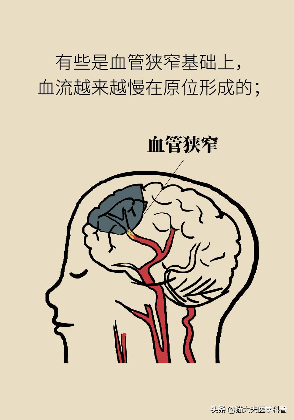 再灌注治疗是什么意思,再灌注治疗