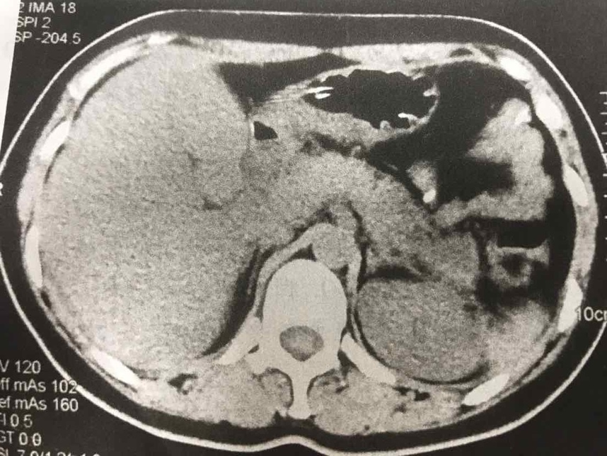 妊娠期胰腺炎常见病因,孕期胰腺炎如何饮食