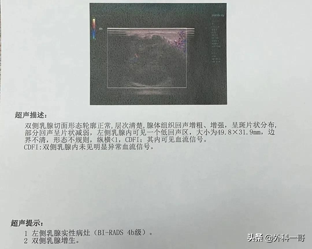 乳腺birads1类是正常乳腺吗,乳腺检查bi-rads一类是什么意思